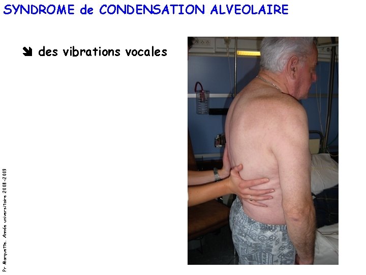 SYNDROME de CONDENSATION ALVEOLAIRE Pr Marquette. Année universitaire 2008 -2009 des vibrations vocales 