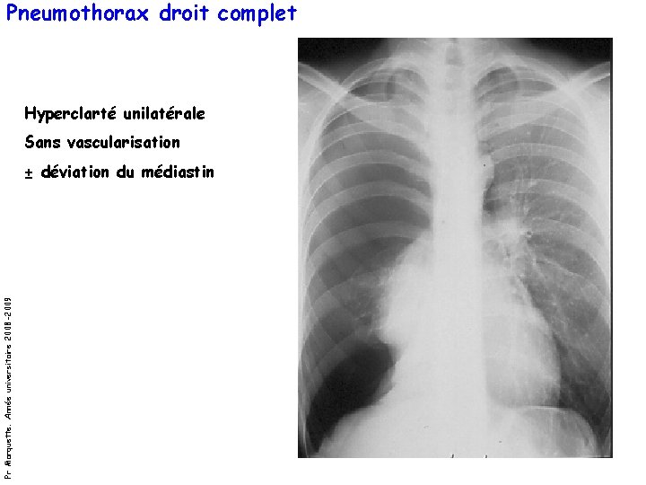 Pneumothorax droit complet Hyperclarté unilatérale Sans vascularisation Pr Marquette. Année universitaire 2008 -2009 ±