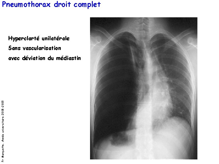 Pneumothorax droit complet Hyperclarté unilatérale Sans vascularisation Pr Marquette. Année universitaire 2008 -2009 avec