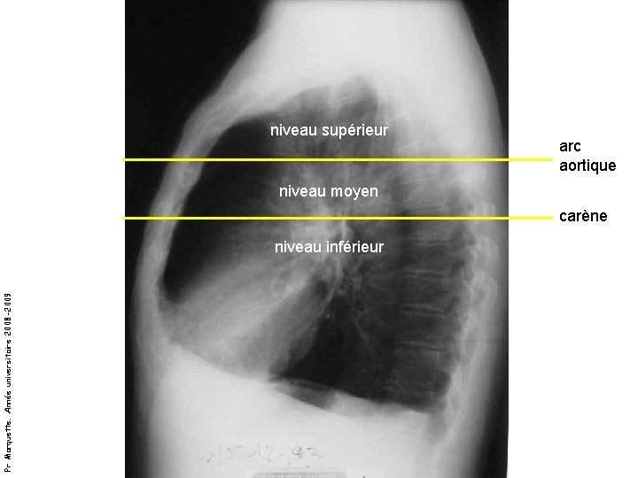 niveau supérieur arc aortique niveau moyen carène Pr Marquette. Année universitaire 2008 -2009 niveau