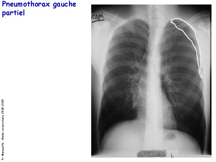 Pr Marquette. Année universitaire 2008 -2009 Pneumothorax gauche partiel 