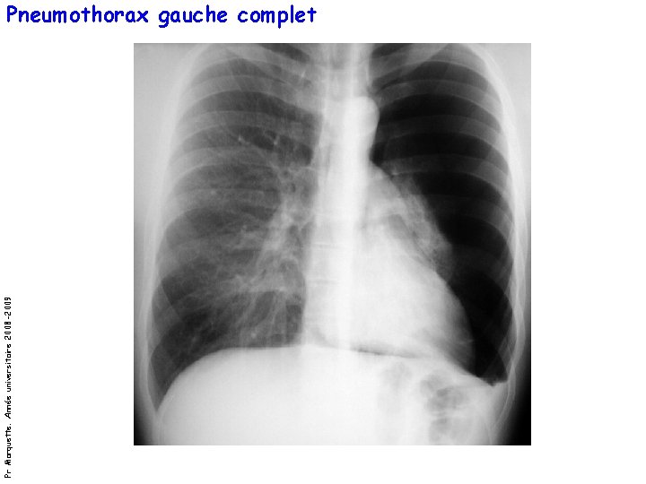 Pr Marquette. Année universitaire 2008 -2009 Pneumothorax gauche complet 