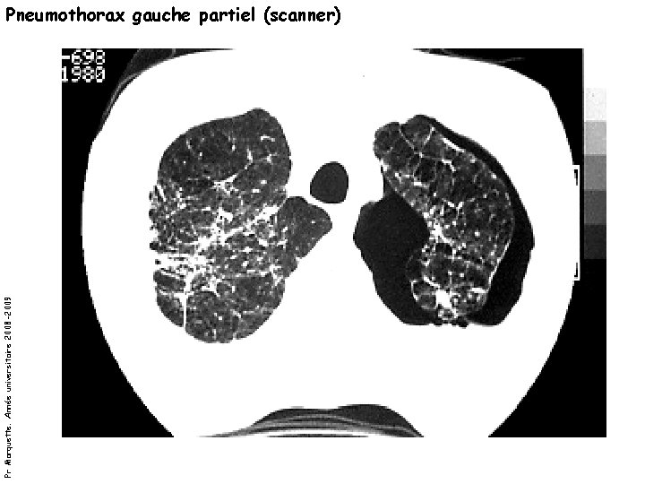 Pr Marquette. Année universitaire 2008 -2009 Pneumothorax gauche partiel (scanner) 