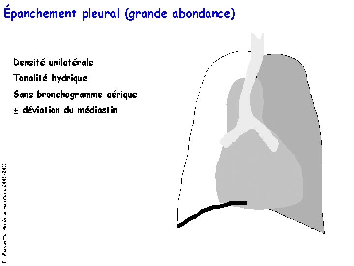 Épanchement pleural (grande abondance) Densité unilatérale Tonalité hydrique Sans bronchogramme aérique Pr Marquette. Année