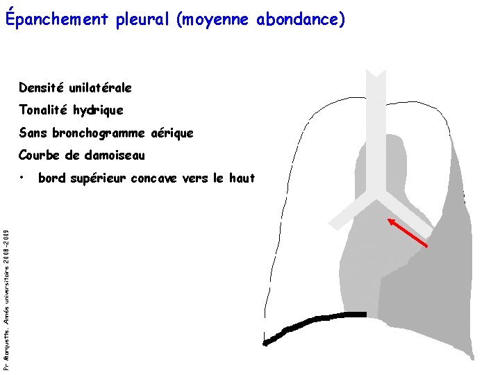 Épanchement pleural (moyenne abondance) Densité unilatérale Tonalité hydrique Sans bronchogramme aérique Courbe de damoiseau