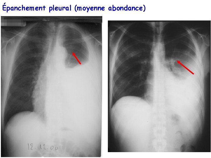 Pr Marquette. Année universitaire 2008 -2009 Épanchement pleural (moyenne abondance) 