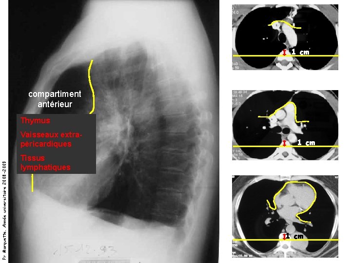 1 cm compartiment antérieur Thymus Pr Marquette. Année universitaire 2008 -2009 Vaisseaux extrapéricardiques 1