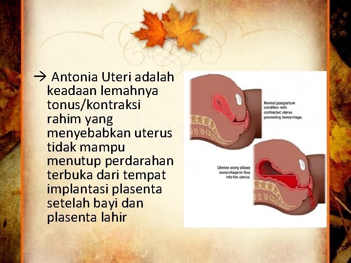  Antonia Uteri adalah keadaan lemahnya tonus/kontraksi rahim yang menyebabkan uterus tidak mampu menutup