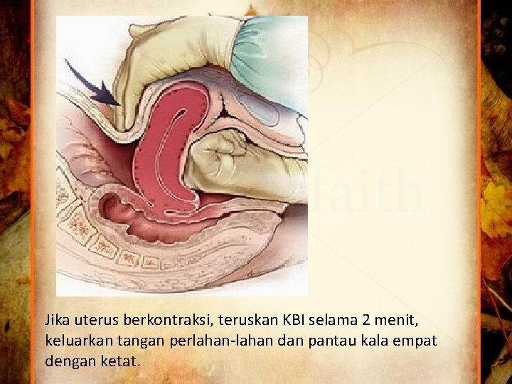 Jika uterus berkontraksi, teruskan KBI selama 2 menit, keluarkan tangan perlahan-lahan dan pantau kala