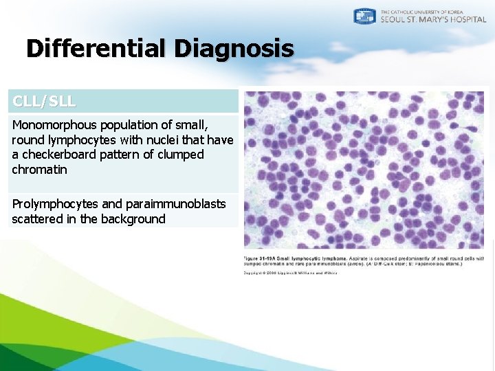 Differential Diagnosis CLL/SLL Mantle cell lymphoma Monomorphous population of small, round lymphocytes with nuclei