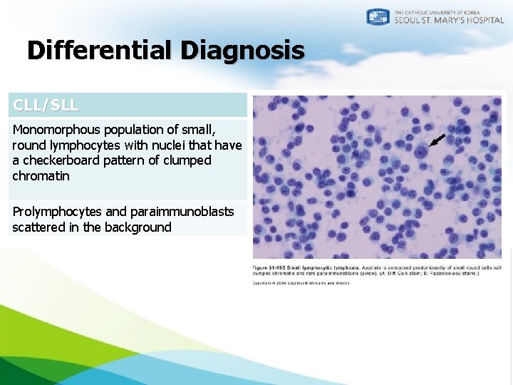 Differential Diagnosis CLL/SLL Mantle cell lymphoma Monomorphous population of small, round lymphocytes with nuclei