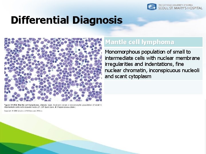 Differential Diagnosis CLL/SLL Mantle cell lymphoma Monomorphous population of small, round lymphocytes with nuclei