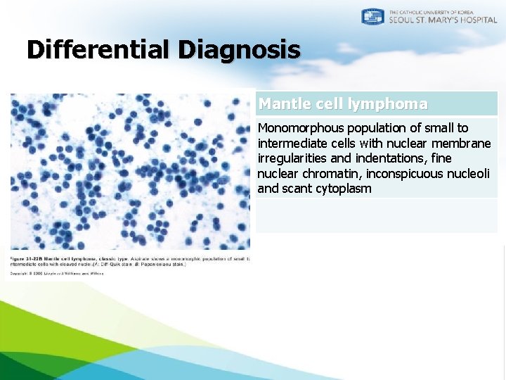 Differential Diagnosis CLL/SLL Mantle cell lymphoma Monomorphous population of small, round lymphocytes with nuclei