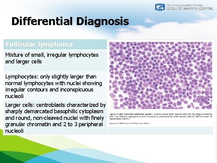 Differential Diagnosis Follicular lymphoma Marginal zone lymphoma Mixture of small, irregular lymphocytes and larger