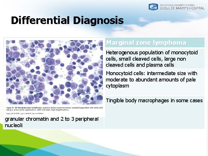 Differential Diagnosis Follicular lymphoma Marginal zone lymphoma Mixture of small, irregular lymphocytes and larger