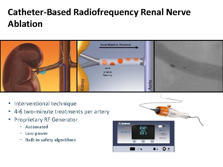 Catheter-Based Radiofrequency Renal Nerve Ablation • Interventional technique • 4 -6 two-minute treatments per