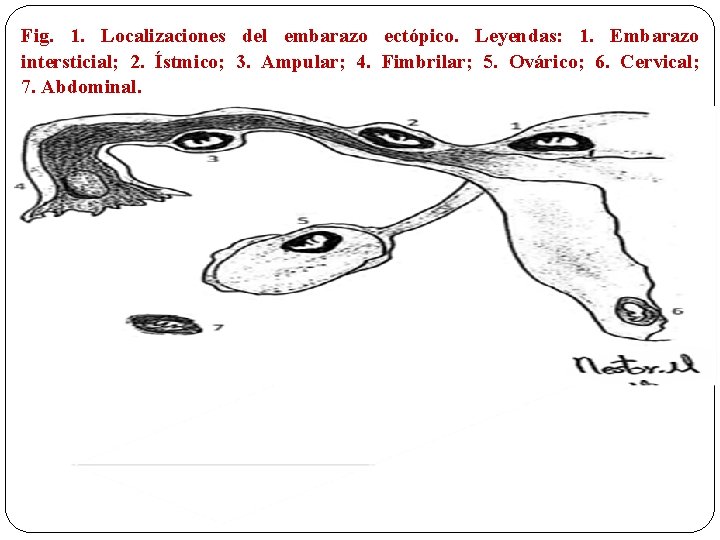 Fig. 1. Localizaciones del embarazo ectópico. Leyendas: 1. Embarazo intersticial; 2. Ístmico; 3. Ampular;