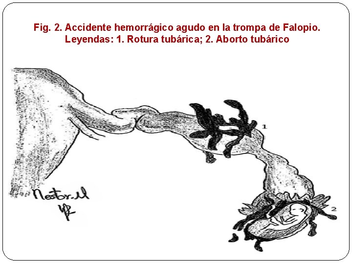 Fig. 2. Accidente hemorrágico agudo en la trompa de Falopio. Leyendas: 1. Rotura tubárica;
