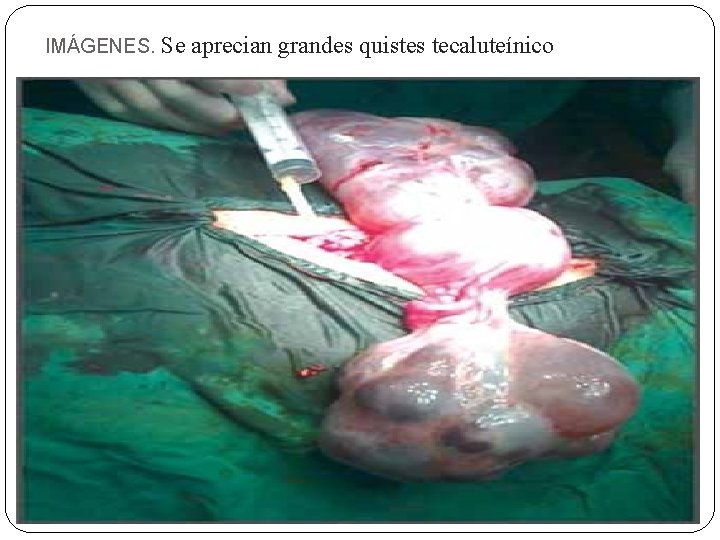 IMÁGENES. Se aprecian grandes quistes tecaluteínico 