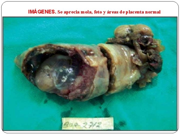 IMÁGENES. Se aprecia mola, feto y áreas de placenta normal 