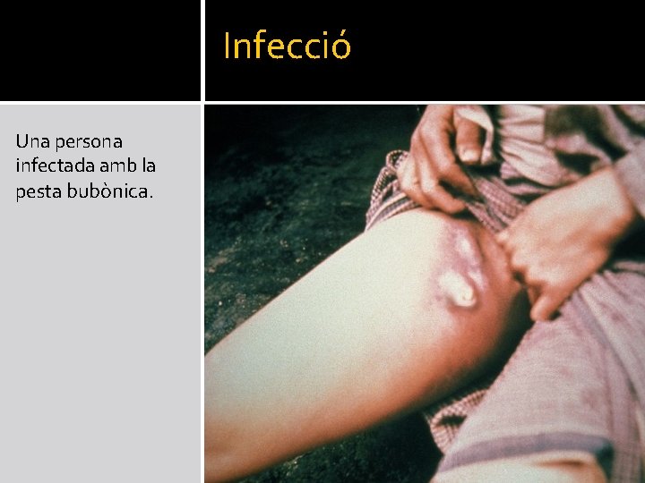 Infecció Una persona infectada amb la pesta bubònica. 