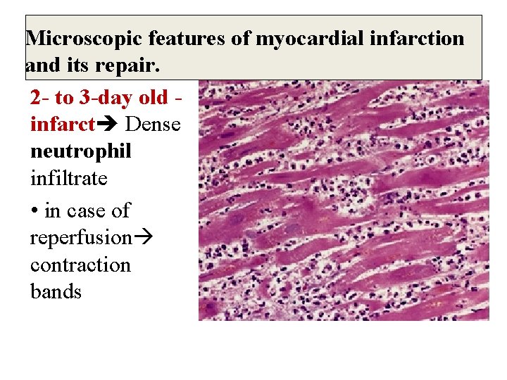 Microscopic features of myocardial infarction and its repair. 2 - to 3 -day old