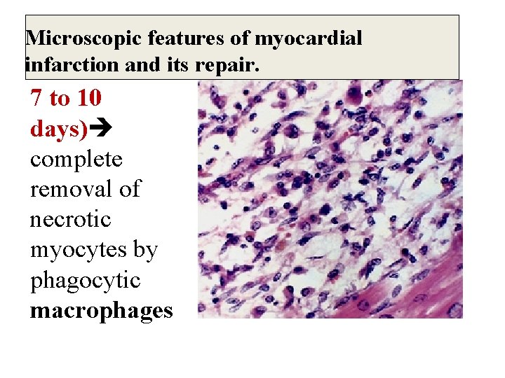 Microscopic features of myocardial infarction and its repair. 7 to 10 days) complete removal
