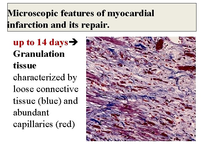 Microscopic features of myocardial infarction and its repair. up to 14 days Granulation tissue