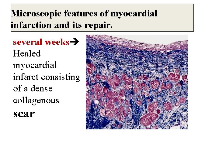 Microscopic features of myocardial infarction and its repair. several weeks Healed myocardial infarct consisting