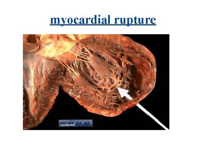 myocardial rupture 