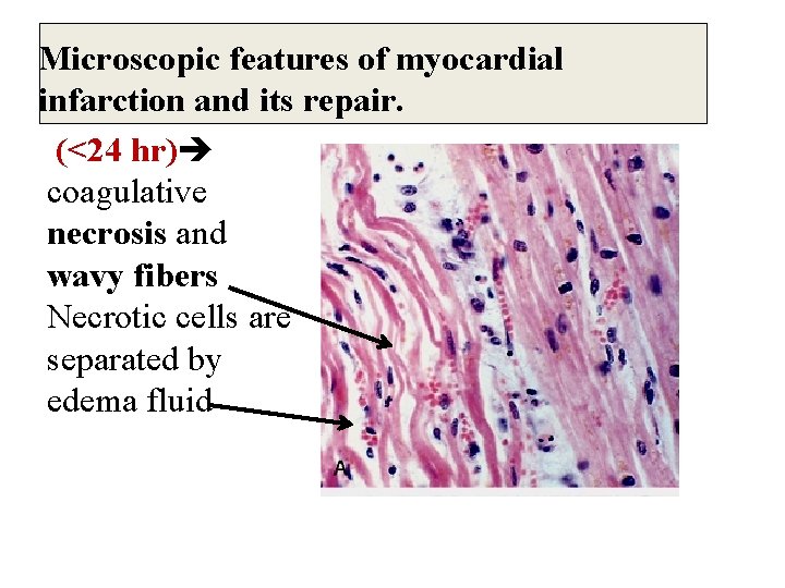 Microscopic features of myocardial infarction and its repair. (<24 hr) coagulative necrosis and wavy
