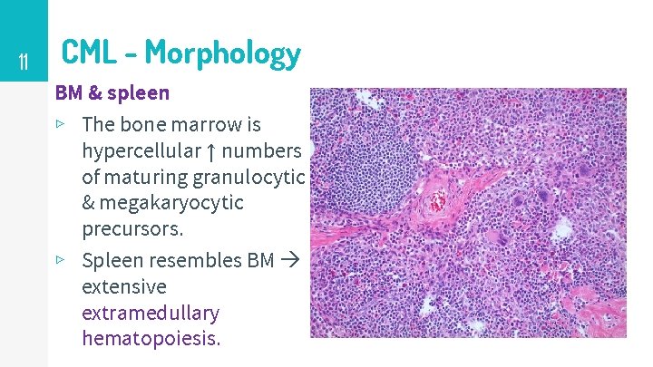 11 CML - Morphology BM & spleen ▹ The bone marrow is hypercellular ↑