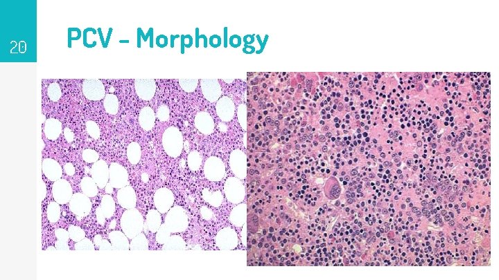 20 PCV - Morphology 