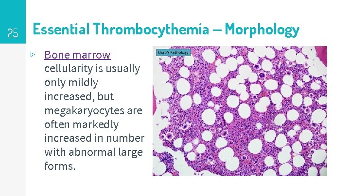 25 Essential Thrombocythemia – Morphology ▹ Bone marrow cellularity is usually only mildly increased,