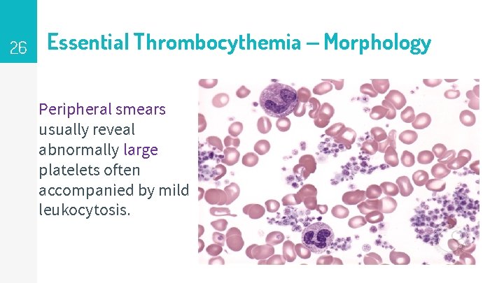 26 Essential Thrombocythemia – Morphology Peripheral smears usually reveal abnormally large platelets often accompanied