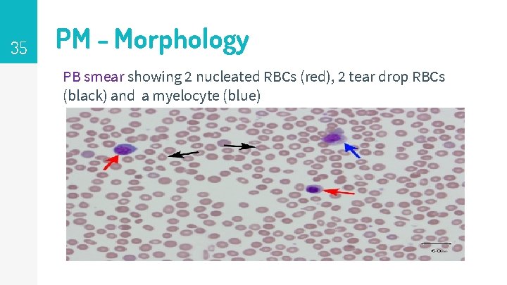 35 PM - Morphology PB smear showing 2 nucleated RBCs (red), 2 tear drop