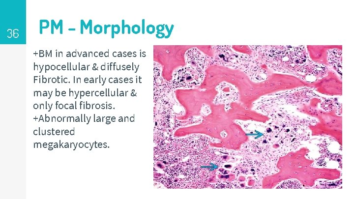 36 PM - Morphology +BM in advanced cases is hypocellular & diffusely Fibrotic. In