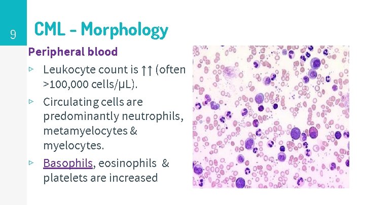 9 CML - Morphology Peripheral blood ▹ Leukocyte count is ↑↑ (often >100, 000