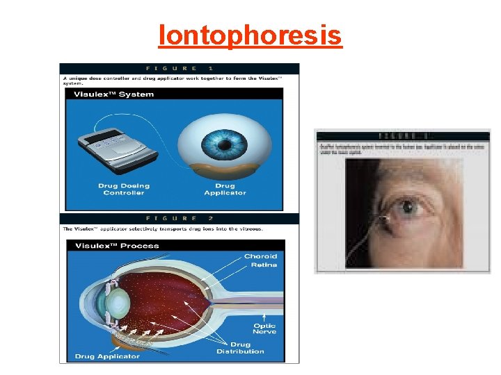 Iontophoresis 