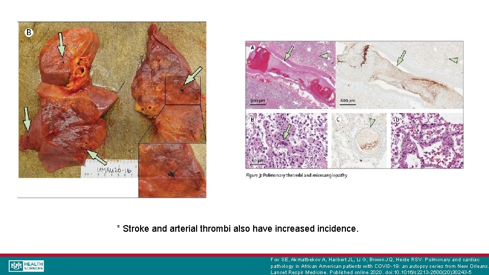 * Stroke and arterial thrombi also have increased incidence. Fox SE, Akmatbekov A, Harbert