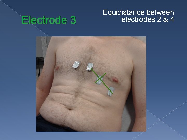 Electrode 3 Equidistance between electrodes 2 & 4 