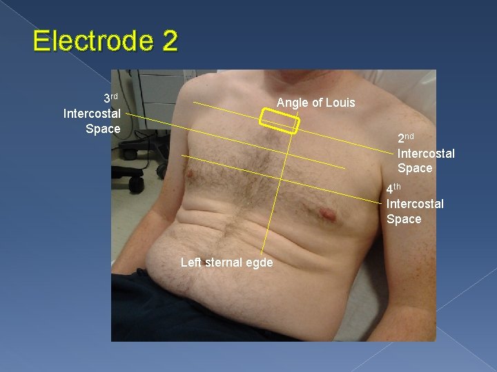 Electrode 2 3 rd Intercostal Space Angle of Louis 2 nd Intercostal Space 4