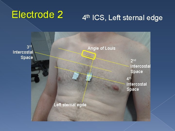 Electrode 2 4 th ICS, Left sternal edge 3 rd Intercostal Space Angle of