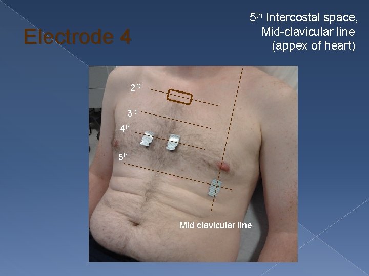 Electrode 4 5 th Intercostal space, Mid-clavicular line (appex of heart) 2 nd 3
