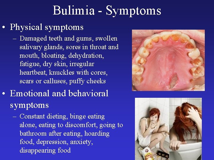 Bulimia - Symptoms • Physical symptoms – Damaged teeth and gums, swollen salivary glands,