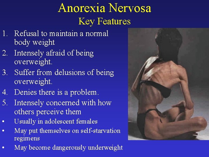 Anorexia Nervosa Key Features 1. Refusal to maintain a normal body weight 2. Intensely