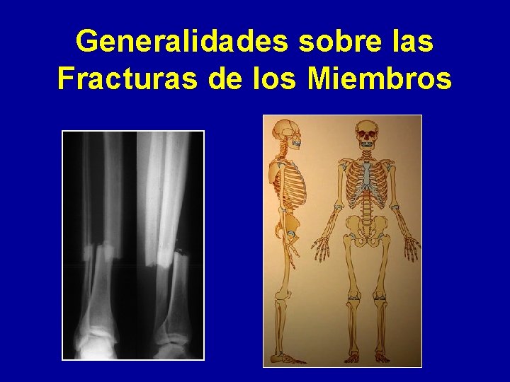 Generalidades sobre las Fracturas de los Miembros 