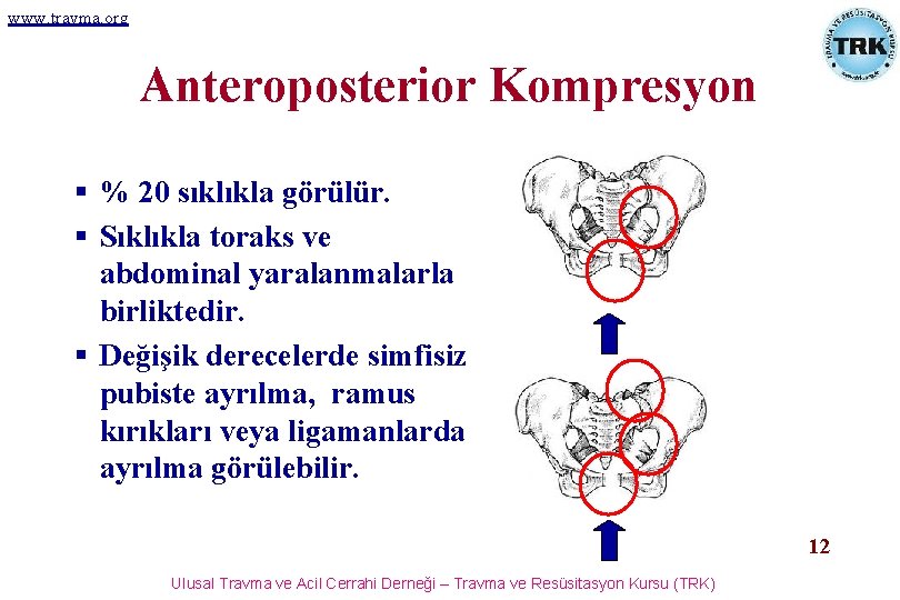 www. travma. org Anteroposterior Kompresyon § % 20 sıklıkla görülür. § Sıklıkla toraks ve