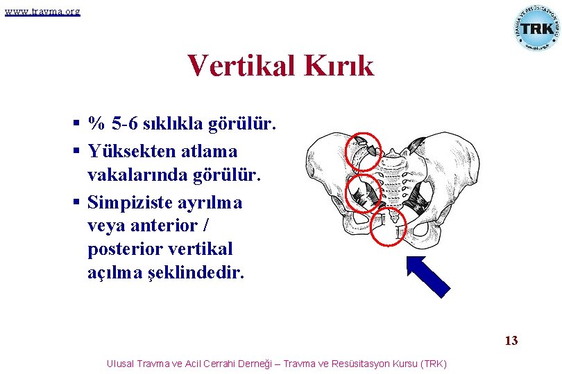 www. travma. org Vertikal Kırık § % 5 -6 sıklıkla görülür. § Yüksekten atlama