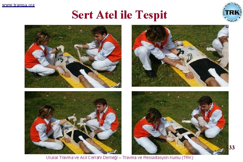 www. travma. org Sert Atel ile Tespit 33 Ulusal Travma ve Acil Cerrahi Derneği